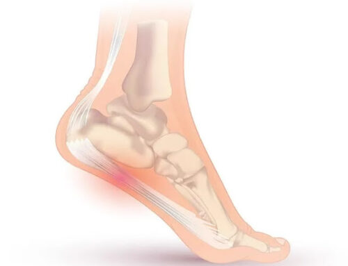 Causes of Planter Fasciitis