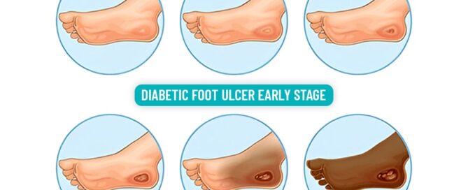 Diabetic Foot Ulcer Early Stage: Warning Signs You Shouldn’t Ignore