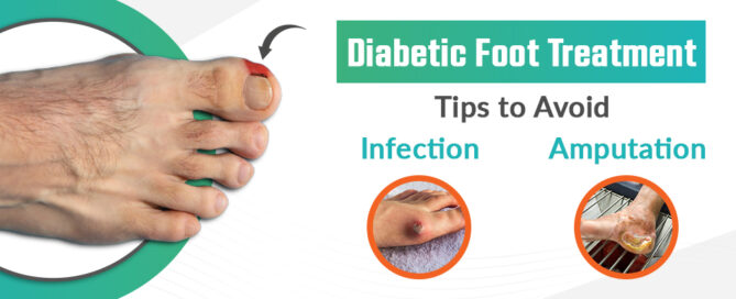 Diabetic Foot Treatment Tips to Avoid Infection and Amputation