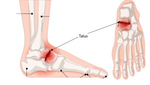Talus Fracture Treatment (1)